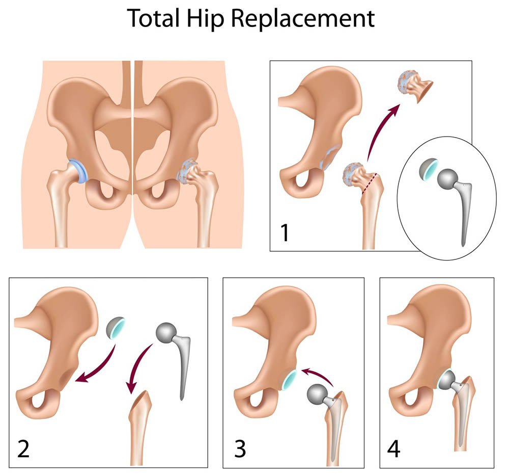 Hip surgery